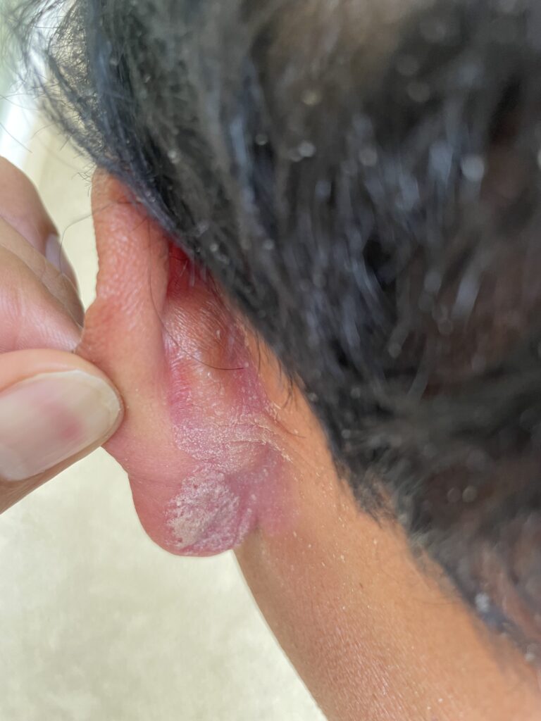 Ear-1 copy
